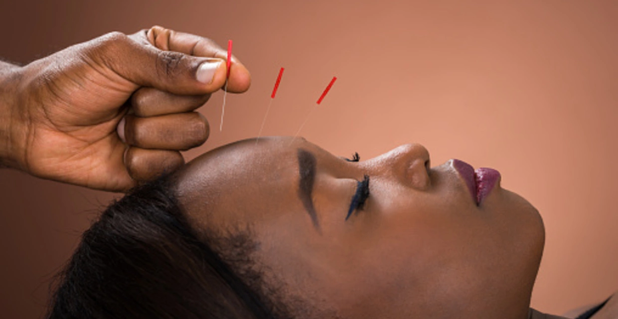 Would You Try Acupuncture After Trauma?