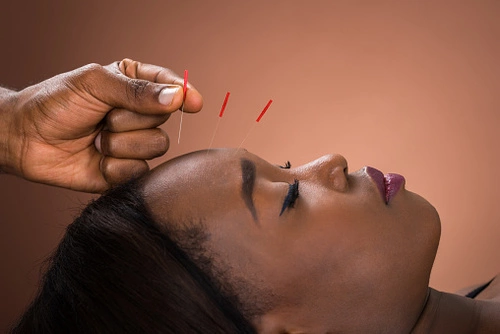 Would You Try Acupuncture After Trauma?